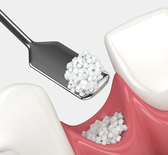 Bone Grafting