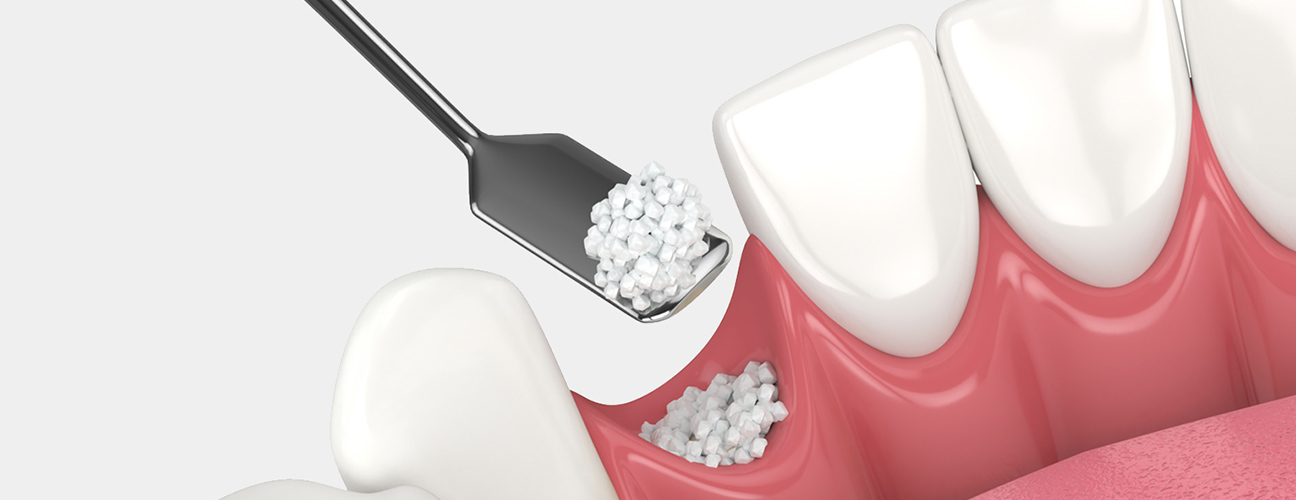 Bone Grafting
