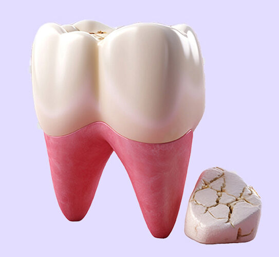 Cracked Tooth