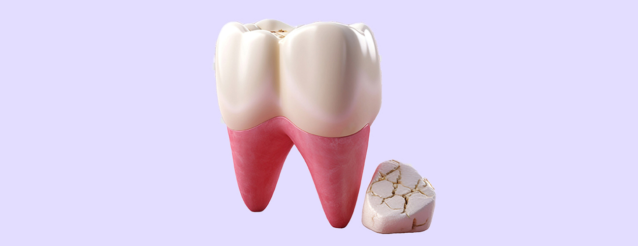 Cracked Tooth