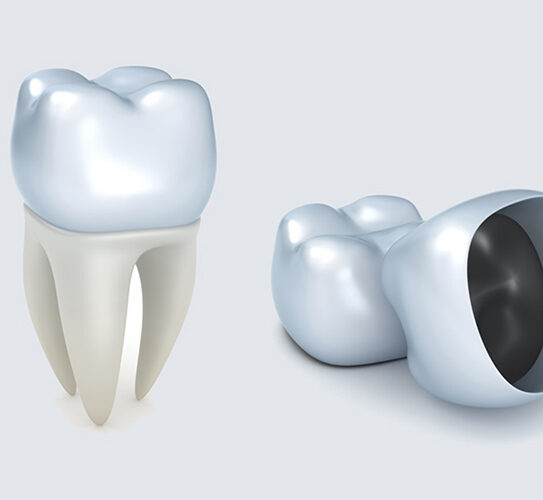 Dental Crowns