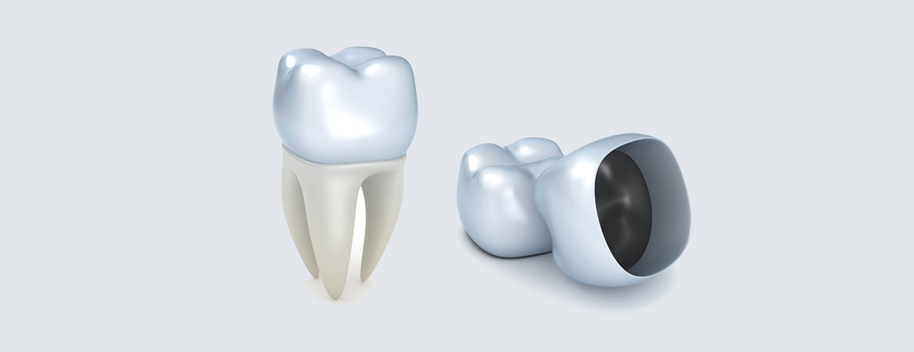 Dental Crowns