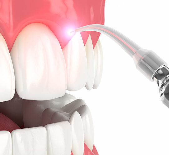 Gum Recession