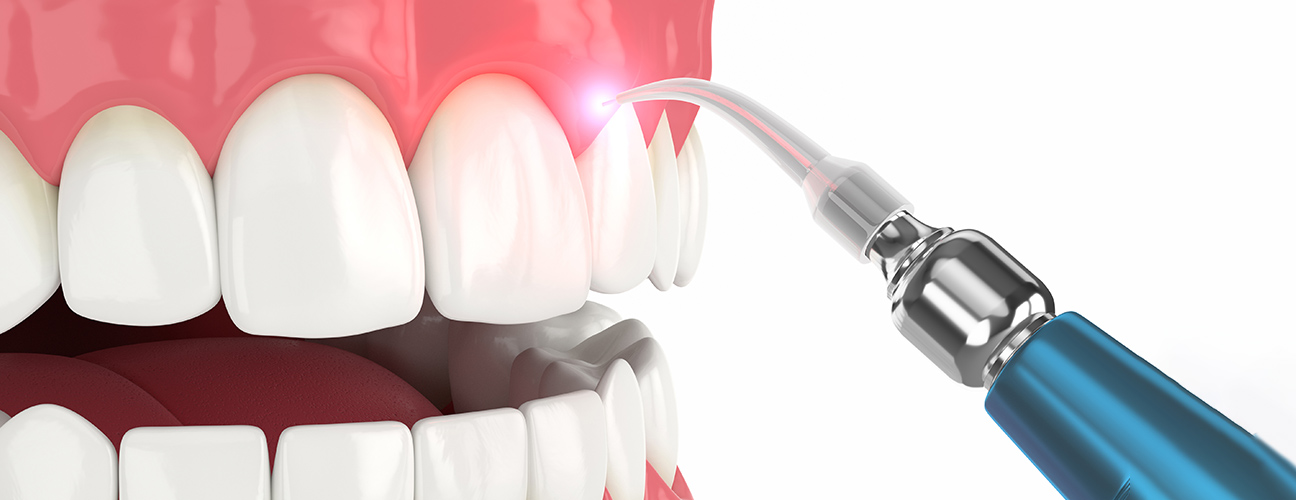 Gum Recession