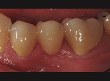 After-before-after
