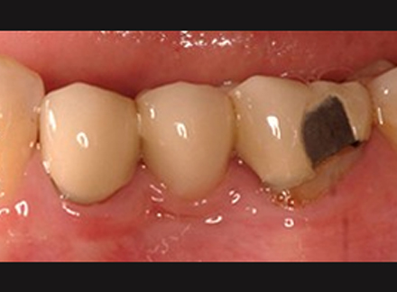 Before-Porcelian