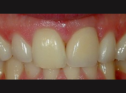 After-before-after