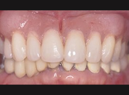 After-before-after