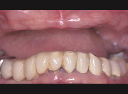 Before-before-after