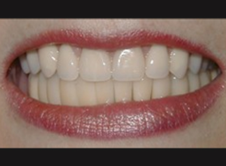 After-before-after