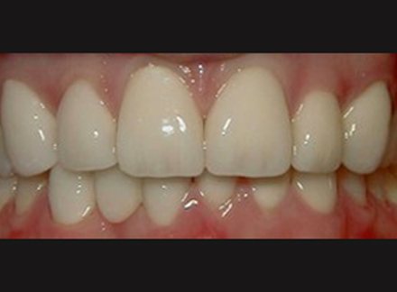 After-before-after