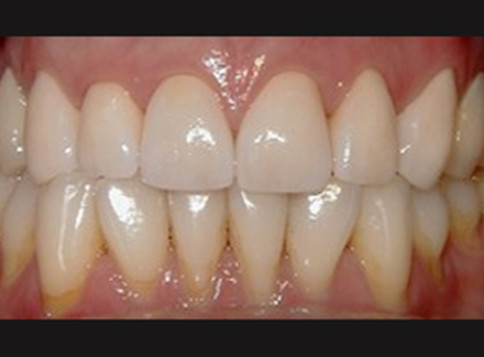 After-before-after
