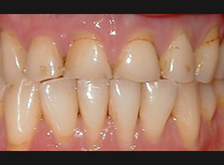 Before-before-after
