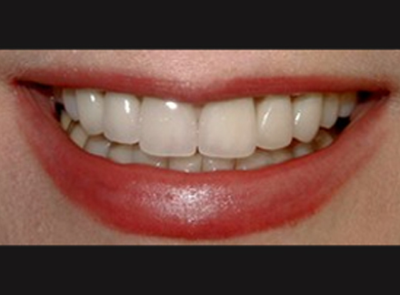 After-before-after
