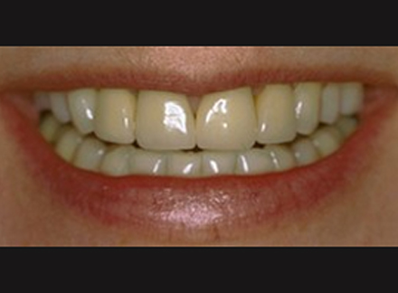 Before-before-after